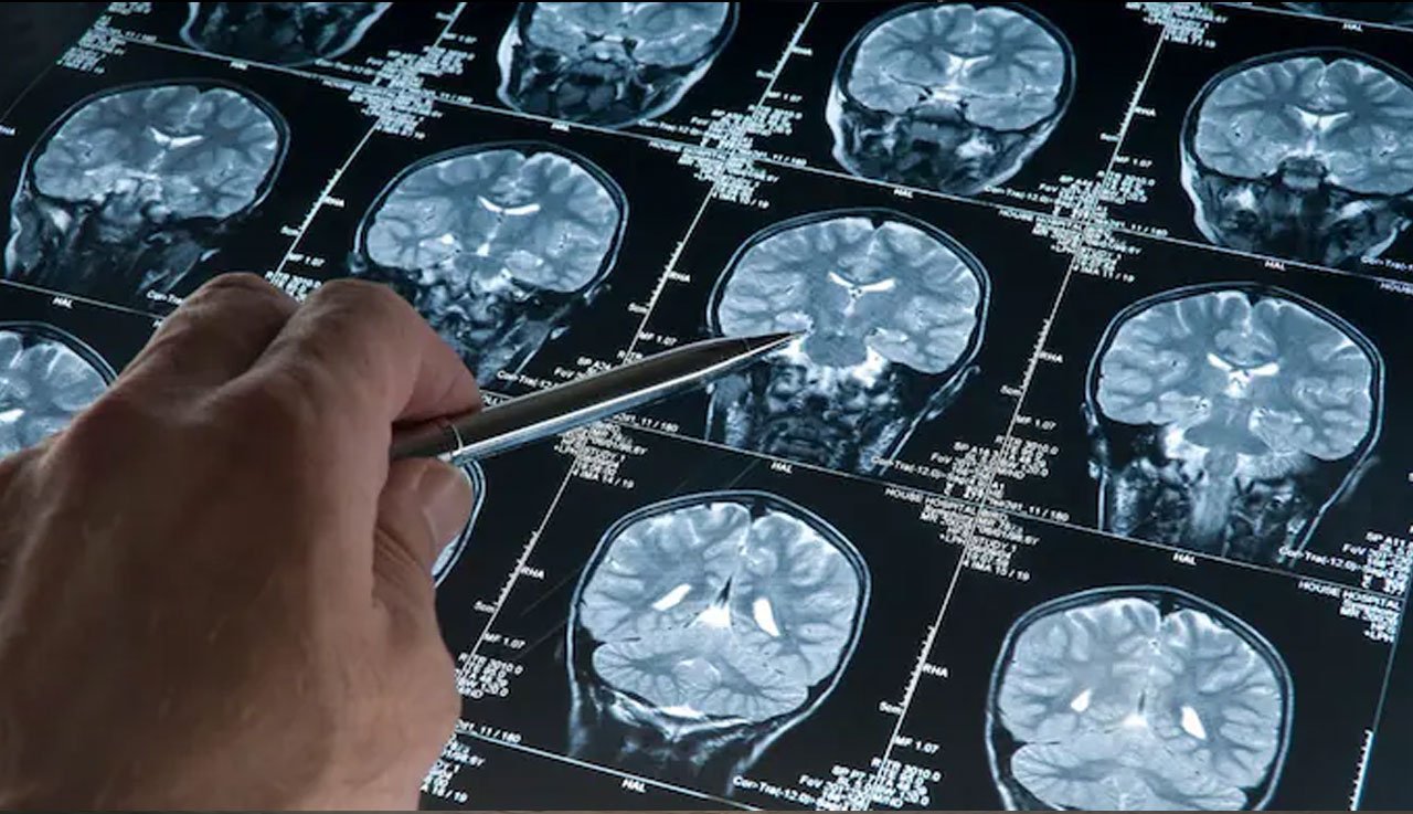 Dementia Diagnosis Takes Over 3 Years